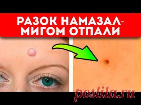 Намазал и забыл, всё само отпало! Копеечные средства + советы врачей, уберут бородавки, папилломы