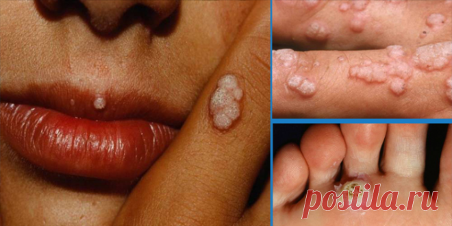 ВНИМАНИЕ! Новое смертельное заболевание хуже, чем ВИЧ! — Домашние заботы