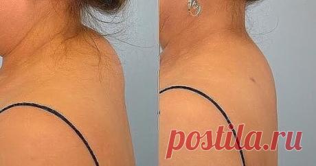 КАК ИЗБАВИТЬСЯ ОТ ХОЛКИ НА ШЕЕ
У многих женщин после 35-40 лет в области седьмого шейного позвонка часто появляется "холка" - жировые отложения у основания шеи. 
Вдовий горбик, загривок, холка, жировик – вот народные названия этой проблемы. Чаще всего данная неприятность настигает женщин, начиная от 40 лет. Почему появляется холка на шее, как избавиться от нее?
У многих женщин после 35-40 лет в области седьмого шейного позвонка часто появляется "холка" - жировые отложения ...