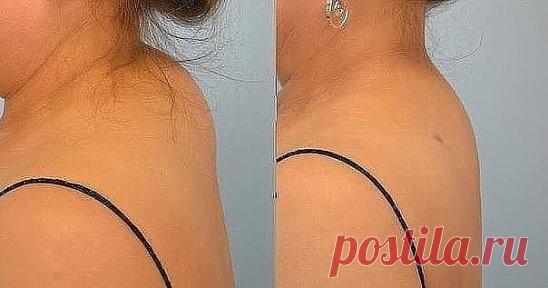 КАК ИЗБАВИТЬСЯ ОТ ХОЛКИ НА ШЕЕ
У многих женщин после 35-40 лет в области седьмого шейного позвонка часто появляется 