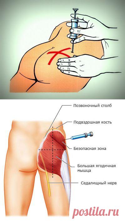 Внутримышечная инъекция в ягодицу: учимся делать самостоятельно — Делимся советами