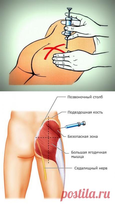 Внутримышечная инъекция в ягодицу: учимся делать самостоятельно — Делимся советами