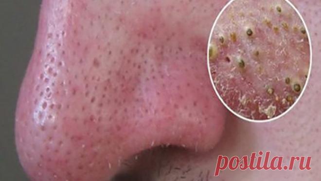 У вас есть прыщи на лице? Избавьтесь от них, естественно и быстро!