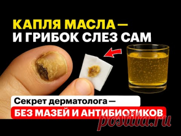 Капнул — и грибок СЛЕЗ С НОГТЯ! Но только если смешать МАСЛО И ....