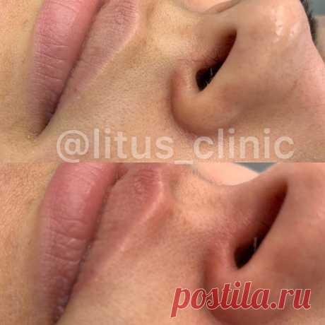 БЕСПОКОЯТ СОСУДЫ ВОКРУГ НОСА ⁉️
👉Всего за 10 минут, быстро и эффективно специалисты нашей клиники удалят их лазером