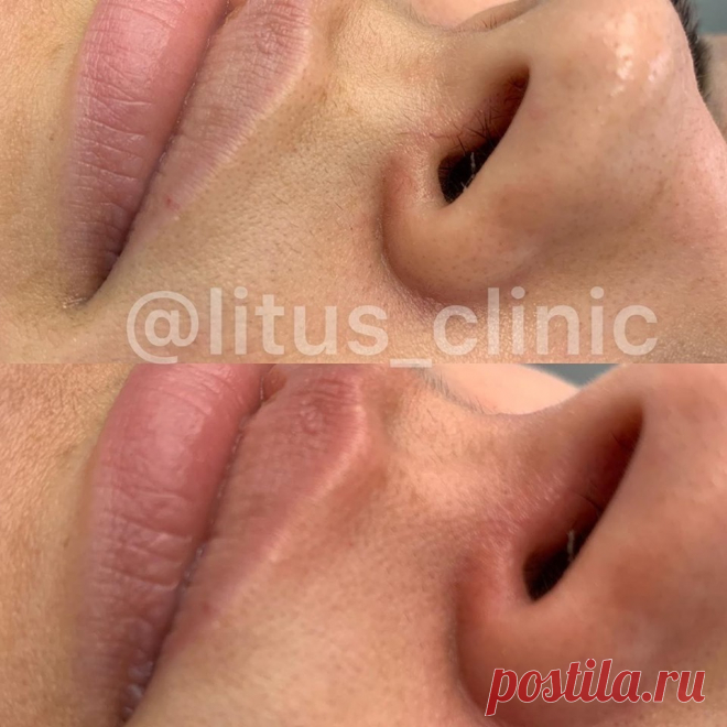 БЕСПОКОЯТ СОСУДЫ ВОКРУГ НОСА ⁉️
👉Всего за 10 минут, быстро и эффективно специалисты нашей клиники удалят их лазером