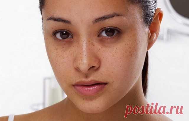 Синяки под глазами: причины появления и лечение народными средствами