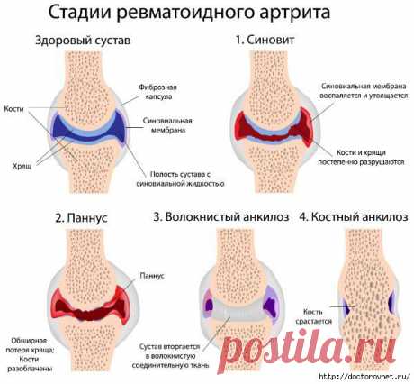 СУПЕРЛЕЧЕНИЕ. КАРТОФЕЛЬ НА КЕФИРЕ ПРОТИВ АРТРИТА.