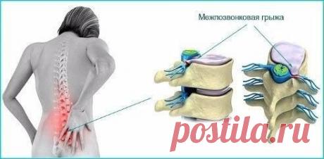 Поясничная грыжа лечится народными способами