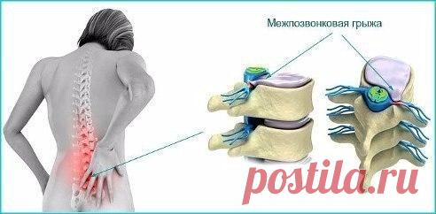 Поясничная грыжа лечится народными способами