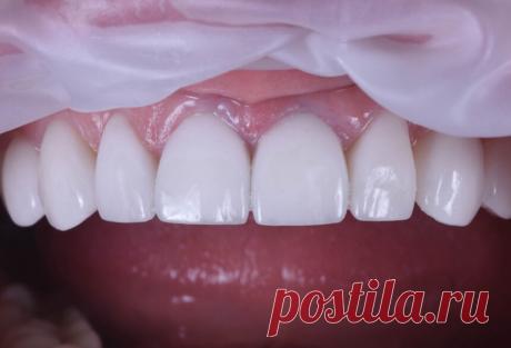 Мифы и правда о винирах - Стоматологическая клиника «Семья» Отвечаем на часто задаваемые вопросы наши пациентов о винирах. Собрали все мифы и правду в одной статье. Давайте разбираться что правда, а что нет!