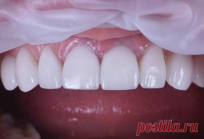 Мифы и правда о винирах - Стоматологическая клиника «Семья» Отвечаем на часто задаваемые вопросы наши пациентов о винирах. Собрали все мифы и правду в одной статье. Давайте разбираться что правда, а что нет!