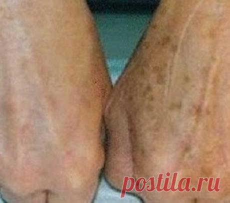 Пигментные пятна на коже