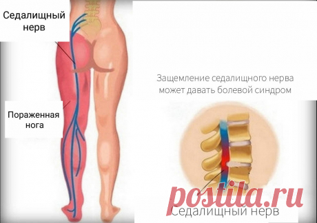 Как снять защемление седалищного нерва в домашних условиях: 3 упражнения | Геннадий Лянго | Яндекс Дзен
