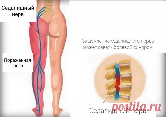 Как снять защемление седалищного нерва в домашних условиях: 3 упражнения | Геннадий Лянго | Яндекс Дзен