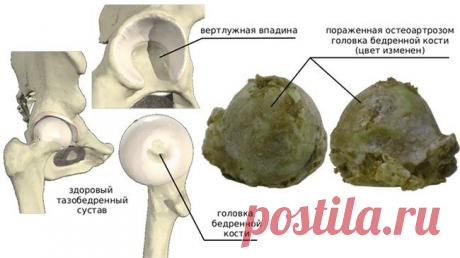 коксартроз тазобедренных суставов - 705 картинок. Поиск@Mail.Ru