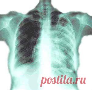 УДАР ПО ТУБЕРКУЛЕЗУ | Друг пенсионера
Мой дед в далекие послевоенные го­ды заболел туберкулезом.