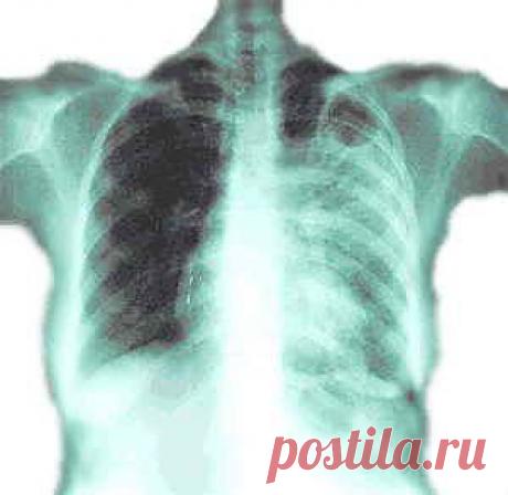 УДАР ПО ТУБЕРКУЛЕЗУ | Друг пенсионера
Мой дед в далекие послевоенные го­ды заболел туберкулезом.