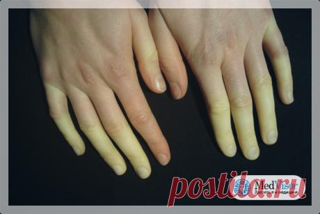 Немеют кисти и пальцы рук: причина и что делать