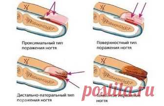 ЛУЧШЕЕ ДОМАШНЕЕ СРЕДСТВО ОТ ГРИБКА НОГТЕЙ, ВСЕГО ИЗ 2 ИНГРЕДИЕНТОВ!

Пожелтение
 и отслаивание ногтевой пластины, появление трещинок и зуд между 
пальцами — симптомы грибковой инфекции. Статистика свидетельствует, что 
каждый 5-й житель Земли страдает от этой проблемы.

Сниженный 
иммунитет, тесная обувь, излишняя потливость ног, лишний вес — факторы, 
способствующие заражению. Если вы заметили у себя на ногах проявления 
грибка, следует действовать незамедлительно!

Средс...
