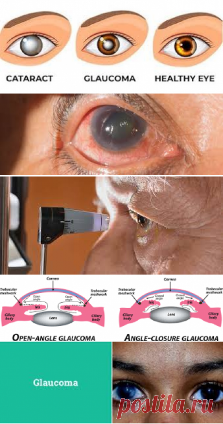 Glaucoma – Google Поиск