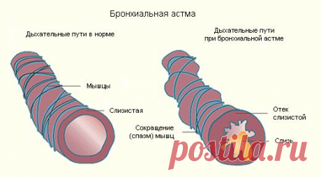 Бронхиальная астма | Доктор Л