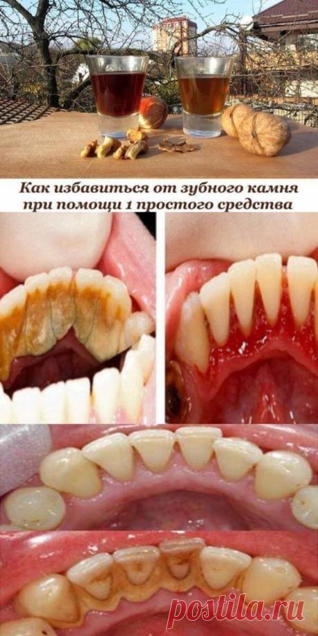 1 классный способ избавиться от зубного камня самому и дома! — Бабушкины секреты