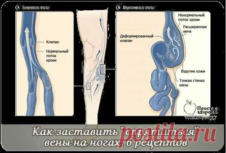 Как заставить ''спрятаться'' вены на ногах. 6 рецептов