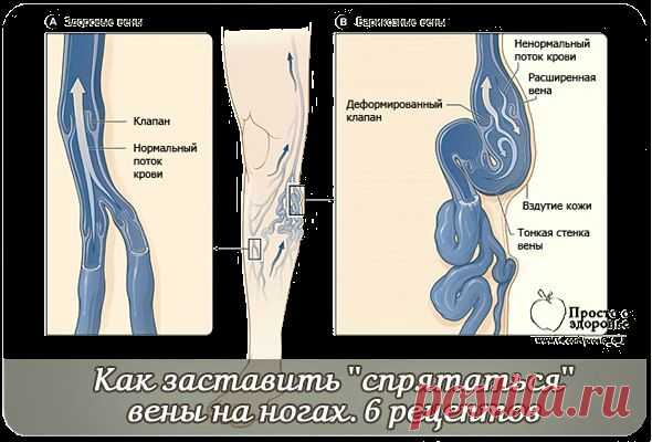 Как заставить ''спрятаться'' вены на ногах. 6 рецептов