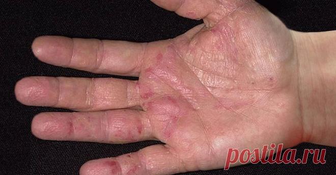 Первые симптомы рака проявляются на руках