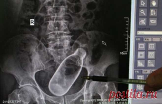 9 неожиданных предметов, которые врачи извлекли из пациентов 


У Вас тут в бутылка...
Хирургов по праву можно считать настоящими волшебниками – они возвращают людей к жизни. Причём порой случается, что люди оказываются на операционном столе по весьма странным …