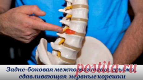 Межпозвоночная грыжа поясничного отдела: симптомы и лечение
