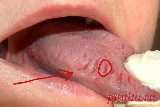 Если вы заметили такие следы у себя на языке, то вам срочно нужна медицинская помощь. Поторопитесь! (6 фото) | Чёрт побери Язык — одна из самых важных частей нашего тела. С его помощью мы говорим, чувствуем вкус, корчим рожи. Но оказывается, взглянув на язык, можно узнать многое и о состоянии наших внутренних органов. Трещины на языке Язык любого человека с годами приобретает подобные трещинки. Но если лет тебе совсем немного, а трещины вдруг появляются одна за другой, схо...