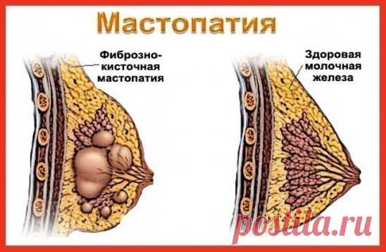 МАСТОПАТИЯ БОИТСЯ ВАЛЕРИАНЫ И ЗВЕРОБОЯ
Услышав от врачей диагноз «мастопатия», многие женщины впадают в отчаяние. И не случайно. Большинство не знает, как это заболевание лечить и как с ним жить. Доктора зачастую никакого лечения не предлагают. Советуют лишь проверять молочные железы каждый год, а вот если уплотнение начнет расти, тогда … придется, видимо, оперировать. Утешение, сами понимаете, слабое. А вот народная медицина знает немало естественных средств, с помощью которых можно облегчить