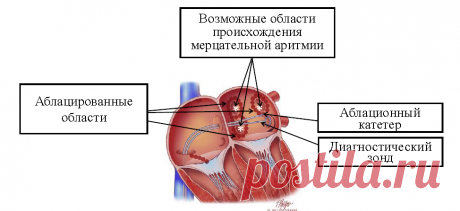 Характер, формы, осложнения, симптомы и диагностика мерцательной аритмии предсердий - Ravijuhend