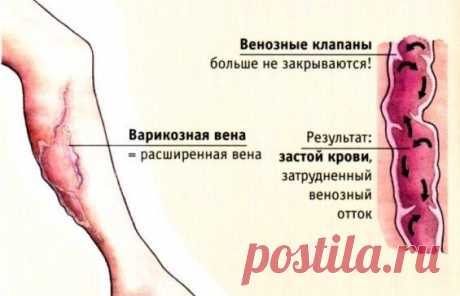ПОДРОБНО О ВАРИКОЗНОМ РАСШИРЕНИИ ВЕН