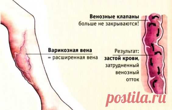 ПОДРОБНО О ВАРИКОЗНОМ РАСШИРЕНИИ ВЕН