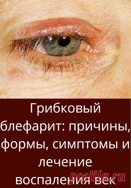 Грибковый блефарит: причины, формы, симптомы и лечение воспаления век