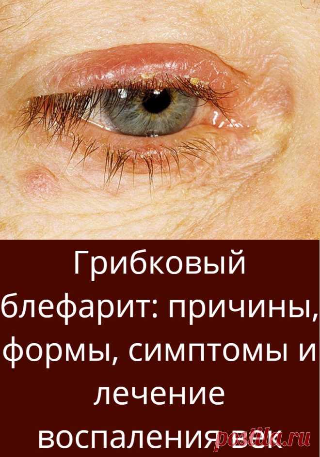 Грибковый блефарит: причины, формы, симптомы и лечение воспаления век