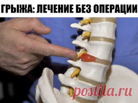 ПОЯСНИЧНАЯ ГРЫЖА ЛЕЧИТСЯ НАРОДНЫМИ СПОСОБАМИ
Поясничная грыжа – это болезнь серьезная! Поясничная грыжа может «напасть», как на молодого человека, так и на пенсионера. От возраста это совершенно не зависит. Люди с поясничной грыжей встречаются и двадцатилетние, и шестидесяти пятилетние.
Поясничная грыжа доставляет очень большие страдания. Постоянная боль не дает нормально жить! Даже шагнув на одну ступеньку, уже хочется вскрикнуть от боли, что уже говорить о том, чтобы подняться, например, на