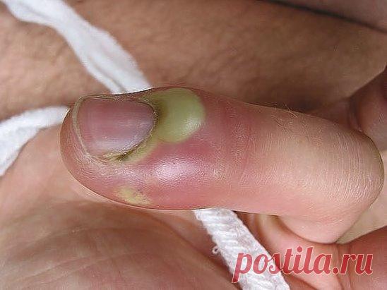 Этот старинный рецепт вытягивает нагноения!
 Вытягивает всю гадость на ура.
Итак, сам рецепт: 1 ч. л. меда 1 ст. л. муки 1 сырой желток Перемешиваем и храним в холодильнике. Накладываем на нужное место, сверху укрываем туалетной бумагой. Меняем повязку каждые 3 часа. Ночью можно не менять. Буквально следующий день без всякой боли начинает выходить гной.
Если ранка болезненная, то просто снимаем бумагу, специально ничего не подчищая накладываем новый слой