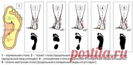 «Детская стопа и её особенности  Детская стопа и её особенности. Вкладыши – подпяточники, вкладыши под передний отдел стопы, под свод стопы, межпальцевые разделители. Травмы – ушибы стоп, растяжения или разрывы капсуло-связочных аппаратов суставов, переломы.» — карточка пользователя мартина м. в Яндекс.Коллекциях