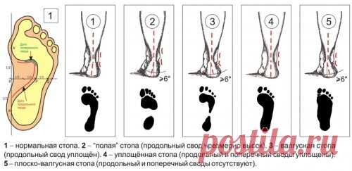 «Детская стопа и её особенности  Детская стопа и её особенности. Вкладыши – подпяточники, вкладыши под передний отдел стопы, под свод стопы, межпальцевые разделители. Травмы – ушибы стоп, растяжения или разрывы капсуло-связочных аппаратов суставов, переломы.» — карточка пользователя мартина м. в Яндекс.Коллекциях
