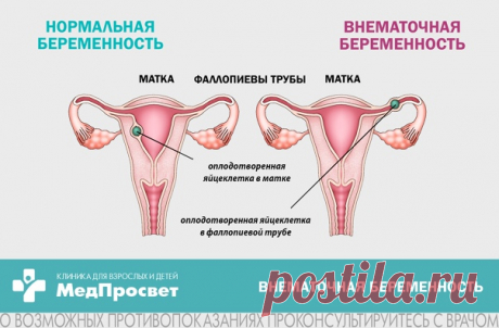 Внематочная беременность – представляет одно из наиболее опасных гинекологических заболеваний, при котором плодное яйцо прикрепляется за пределами полости матки.

 Какие существуют симптомы внематочной беременности на ранних сроках беременности?

Проявления внематочной беременности в раннем сроке не специфичны. Могут быть типичные признаки раннего срока беременности:
Показать полностью...