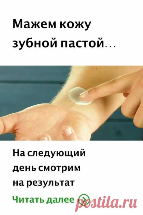 Небольшой синяк — это, конечно, не так уж и страшно. Но если нужно все же избавиться от пятна на коже, есть простой и действенный метод. Мажем синяк зубной пастой, накладываем сверху ватный диск и закрепляем с помощью бинта. Наутро синяк исчезнет.