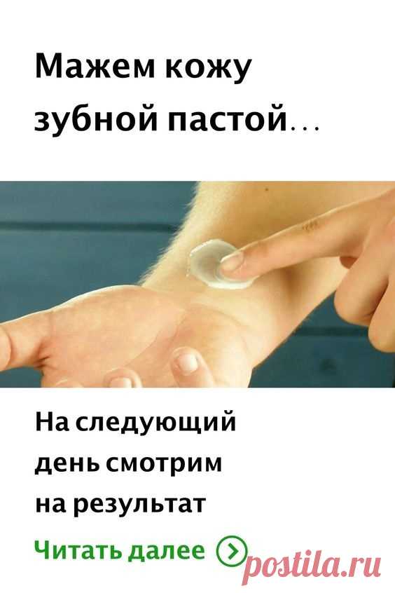 Небольшой синяк — это, конечно, не так уж и страшно. Но если нужно все же избавиться от пятна на коже, есть простой и действенный метод. Мажем синяк зубной пастой, накладываем сверху ватный диск и закрепляем с помощью бинта. Наутро синяк исчезнет.