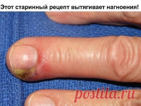 Этот старинный рецепт вытягивает нагноения! Вытягивает всю гадость на ура. Итак, сам рецепт: 1 ч. л. меда 1 ст. л. муки 1 сырой желток Перемешиваем и храним в холодильнике. Накладываем на нужное