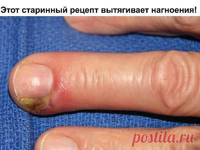Этот старинный рецепт вытягивает нагноения! Вытягивает всю гадость на ура. Итак, сам рецепт: 1 ч. л. меда 1 ст. л. муки 1 сырой желток Перемешиваем и храним в холодильнике. Накладываем на нужное