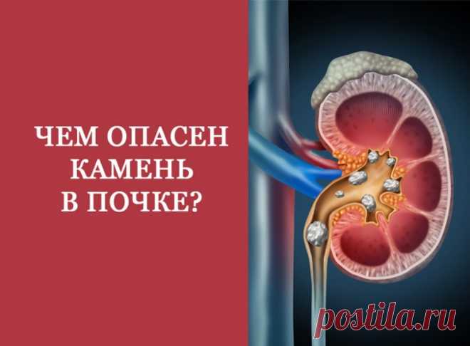 Гидронефроз — это заболевание почки, характеризующееся расширением ее чашечек и лоханки, прогрессирующим истончением почечной ткани, сопровождающееся нарушением всех основных функций почки. Гидронефроз может быть врождённым или приобретённым вседствие других заболеваний.