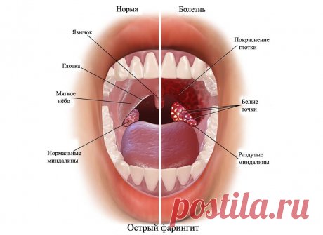 Симптомы и лечение фарингита. Лечим боль в горле